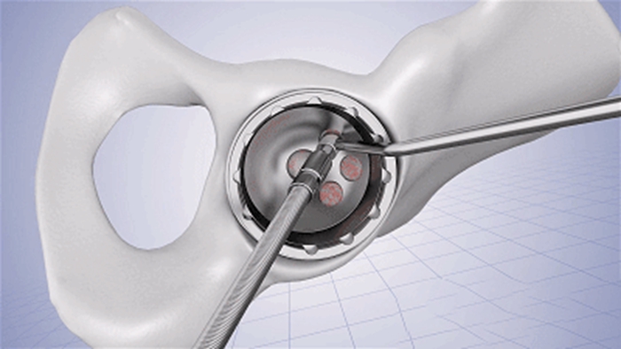Machining, 3D Printing and Implantation Process of Acetabular Cup Machining, 3D Printing and Implantation Process of Acetabular Cup