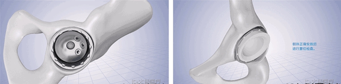 Machining, 3D Printing and Implantation Process of Acetabular Cup Machining, 3D Printing and Implantation Process of Acetabular Cup