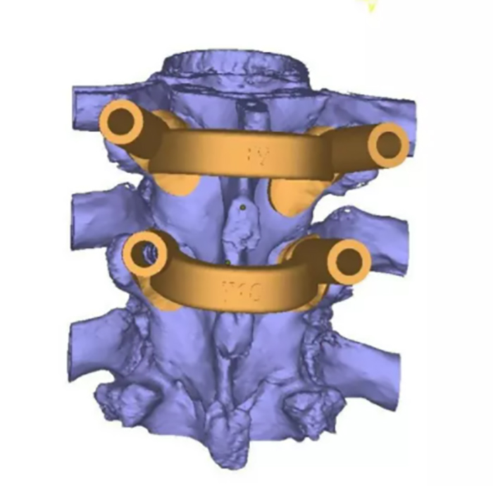 3D Printed Surgical Guide for Medical Application 3D Printed Surgical Guide for Medical Application