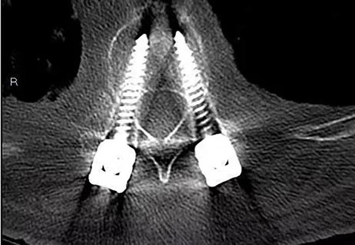 3D Printed Surgical Guide for Medical Application 3D Printed Surgical Guide for Medical Application