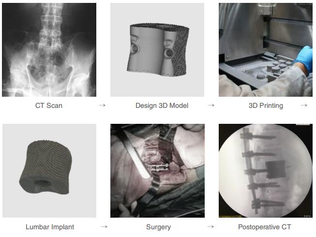 Direct 3D Printed Titanium Alloy Spinal Implants Direct 3D Printed Titanium Alloy Spinal Implants