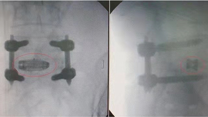 Spinal Implant Manufacturing Using EP-M250 Metal 3D Printer Spinal Implant Manufacturing Using EP-M250 Metal 3D Printer