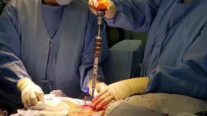 Spinal Implant Manufacturing Using EP-M250 Metal 3D Printer Spinal Implant Manufacturing Using EP-M250 Metal 3D Printer