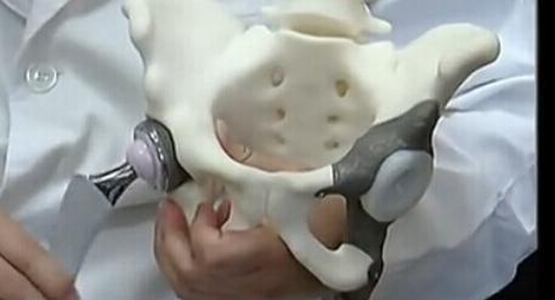 3D Printing For Orthopedic Implant 3D Printing For Orthopedic Implant