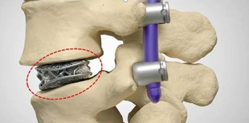 What Metal Material is More Suitable for Implants Printing? What Metal Material is More Suitable for Implants Printing?