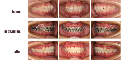 Orthodontic Treatment With Tooth Extraction For Mandibular Retrognathia 